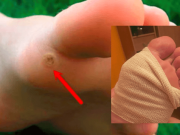 Toto je nejúčinnější bezbolestná metoda, jak se zbavit bradavic. Naučila mě to moje teta a mám to odzkoušené už léta!