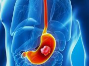 8 příznaků rakoviny žaludku, jsou téměř nepostřehnutelné: Myslíte si, že je to jen špatné trávení, ale toto je nejnebezpečnější