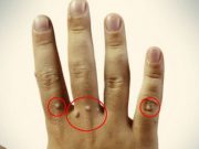 10 nejlepších lidových způsobů, jak odstranit bradavice