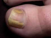 MÁTE TAKOVÉ ŽLUTÉ ZNEHTY: Namažte tento olejíček a problém vyřešíte přes noc, TOHLE JE POSTUP