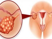 Skrytá nemoc, o které by měla vědět každá žena! To stojí za menstruačními poruchami!