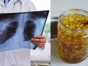 LÉKAŘI NEVĚŘÍ VLASTNÍM OČÍM! Vyléčili těžkou formu rakoviny plic! Tohle je recept!