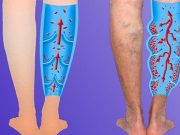 7 cviků na křečové žíly – ke zmírnění bolesti, otoků a zmírnění příznaků
