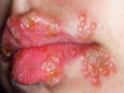 Toto je jediný přírodní lék na herpes, který funguje během několika hodin!