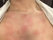 DĚLAJÍ SE VÁM PO SPRCHOVÁNÍ ČERVENÉ SKVRNY? To znamená jediné