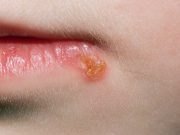 Opar: Vše, co potřebujete vědět o HERPES
